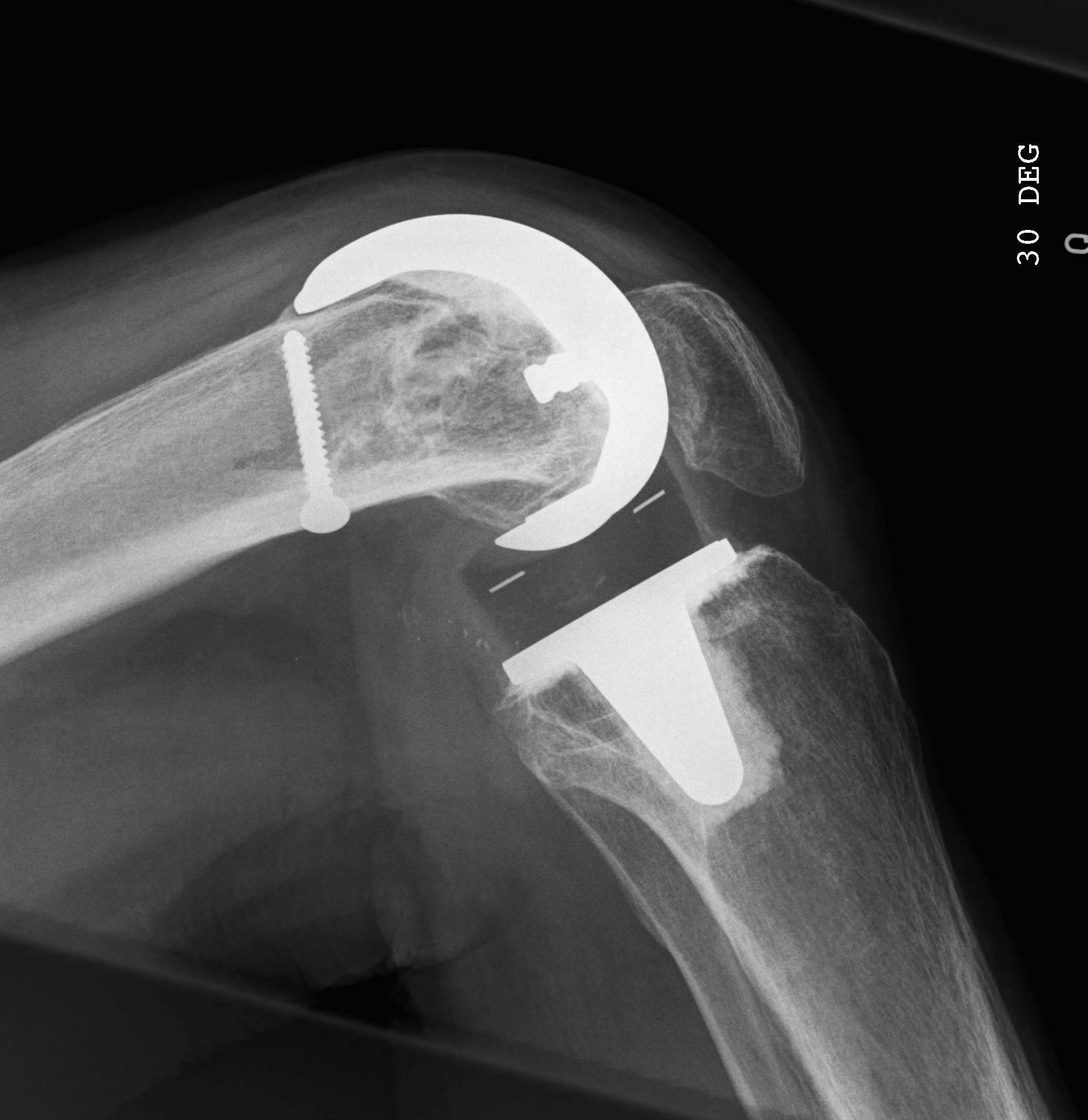 TKR Condylar Fracture Lateral